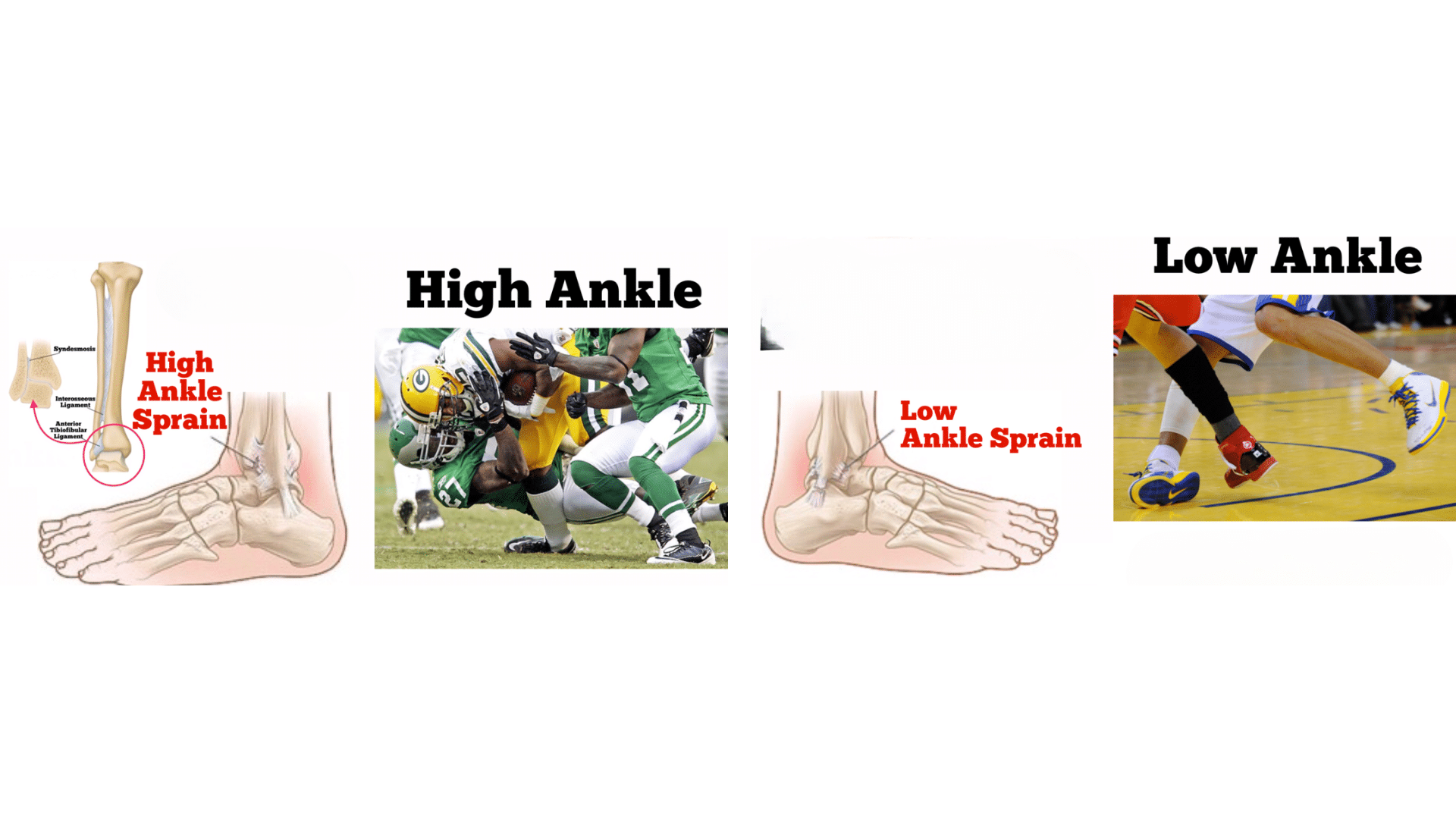 high vs low ankle