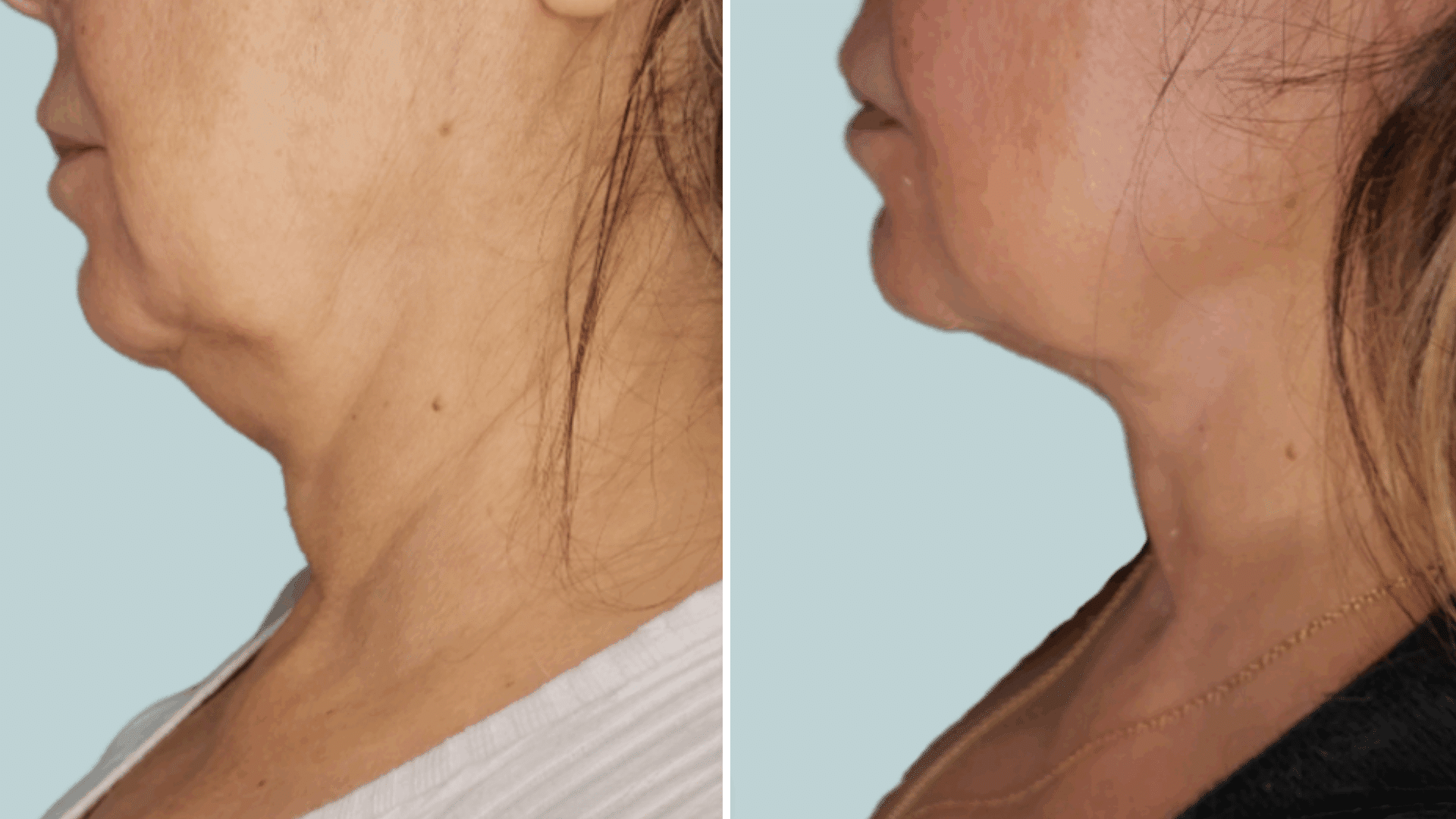 neck throat firmness