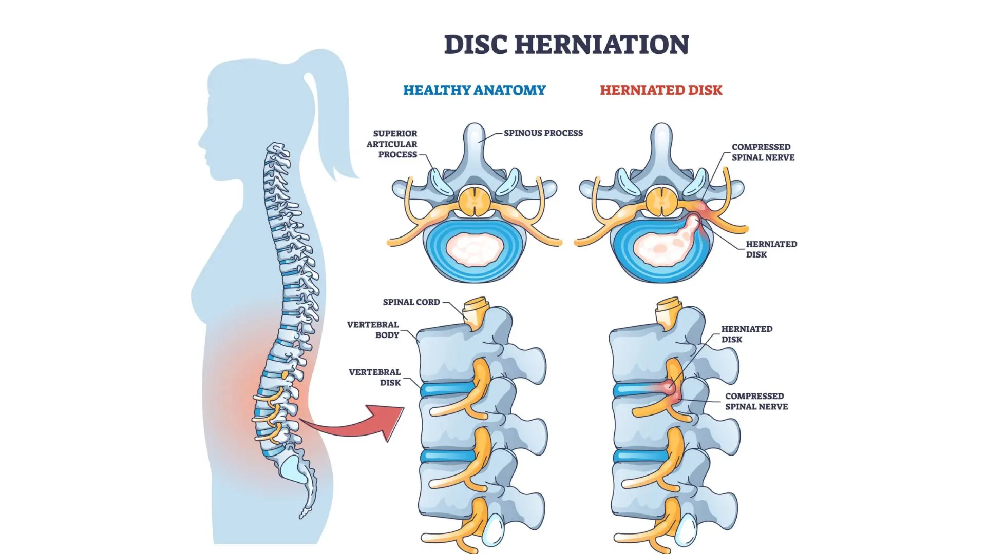 diagram illustrating a healthy spinal disc next to a herniated L5-S1 disc compressing an adjacent spinal nerve root